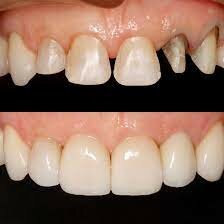 Dientes de porcelana