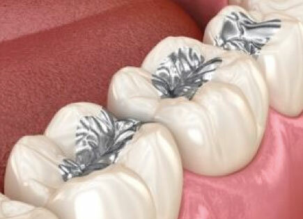 Amalgama. Material de restauración directo.