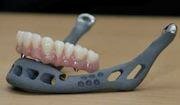 Primer implante de prótesis de mandíbula impreso en 3D