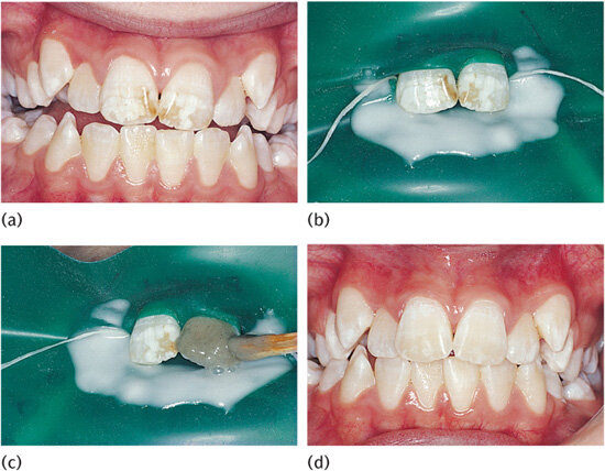 The hydrochloric acid–pumice micro-abrasion technique