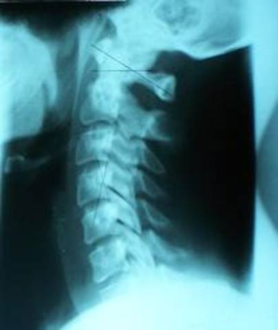 Caroline transfers to a chiropractic college