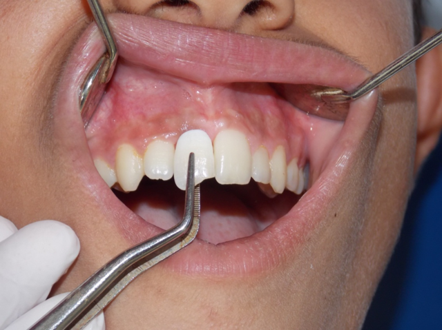 Resina reforzada con fibra