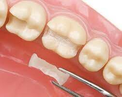 Incrustaciones de porcelana