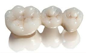 Zirconia In-Ceram