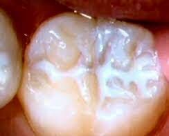 Selladores de fosetas y fisuras