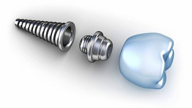 Titanio en implantología