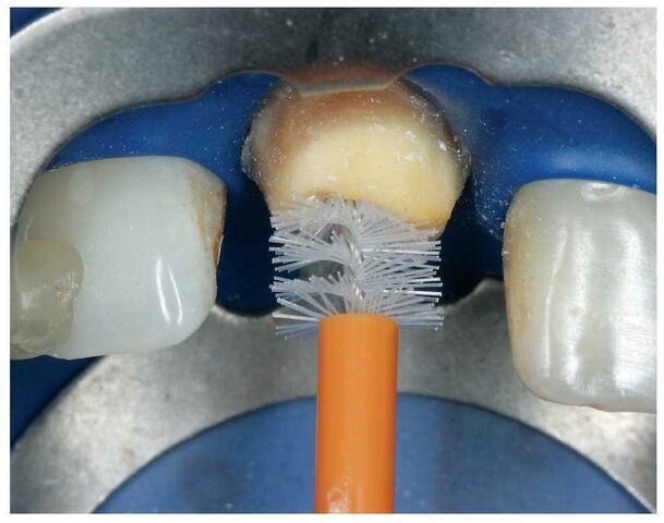 1.	1960 Primeros intentos de utilizar cemento reforzado con fibra en la odontología clínica.