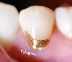 Oro para restauraciones