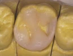 Restauraciones semidirectas