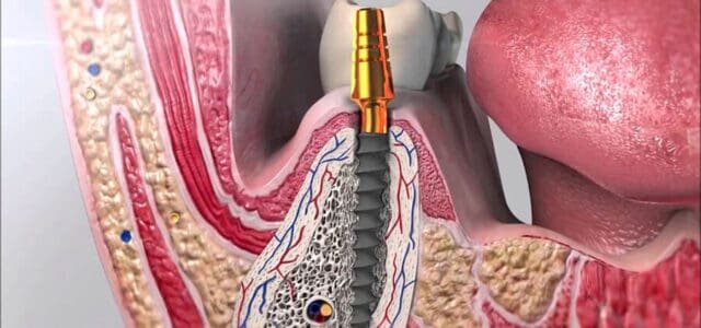 Osteointegración e implante de Titanio.