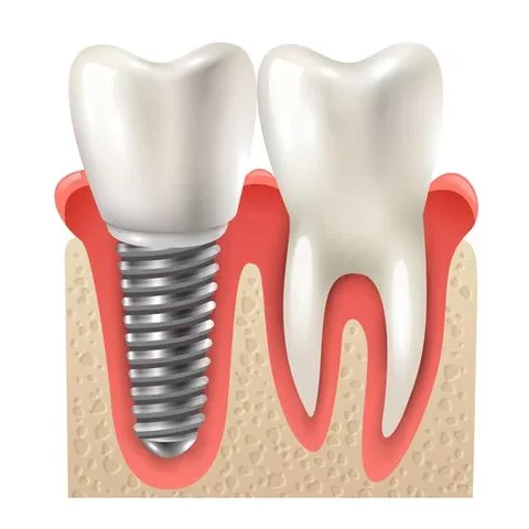Primer implante dental