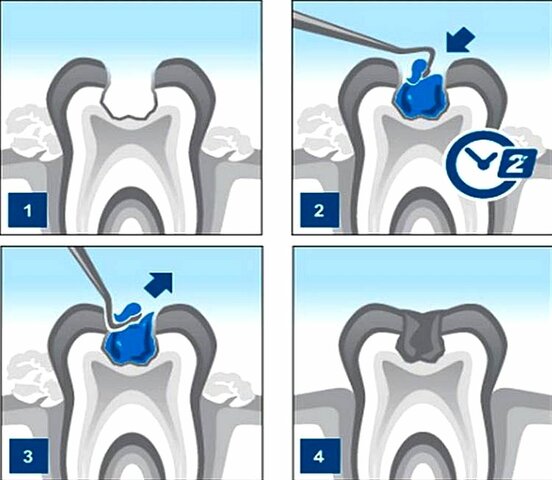 Remoción de caries químico - mecánica