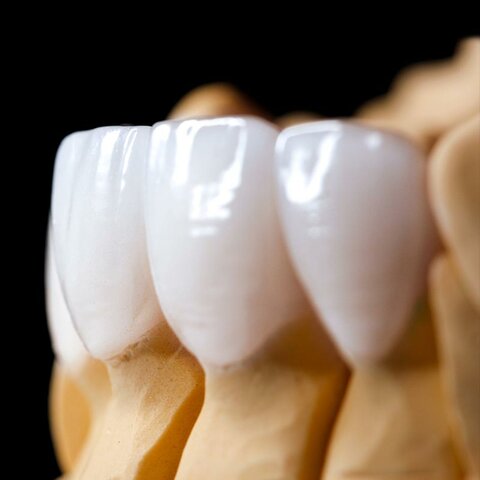Dientes de porcelana