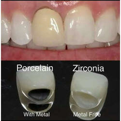 Inceramic Zirconia