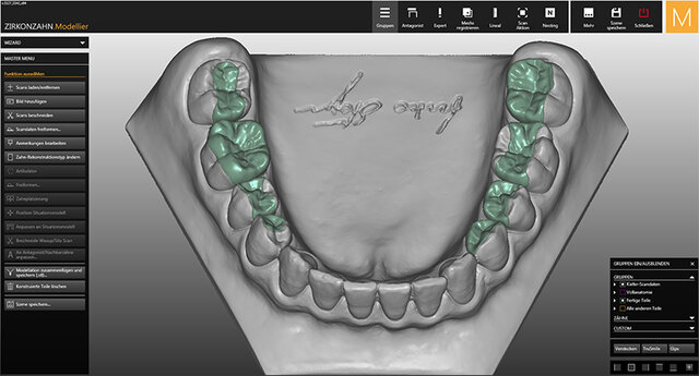 CAD/CAM inlays onlays