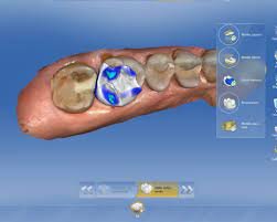 Implante dental fabricado con el sistema CAD/CAM