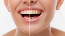 Timeline: Odontología Restauradora