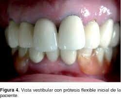 Técnica de prótesis parciales )FPD0