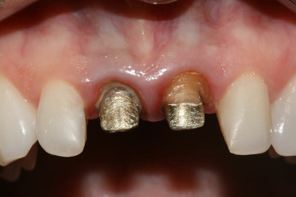 Sistema de cerámica metálica