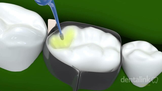 Comienza la era de las resinas modernas