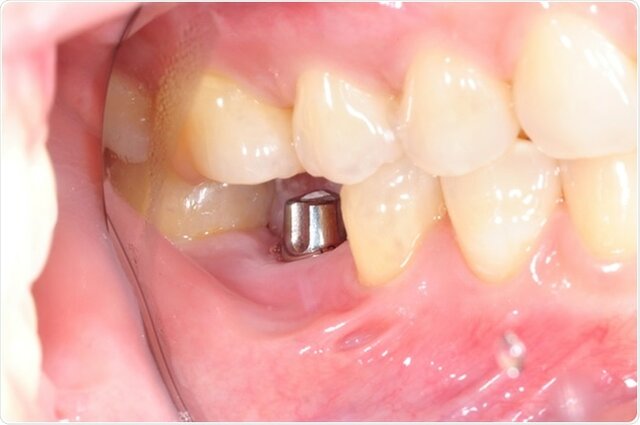 Primer implante dental titanium