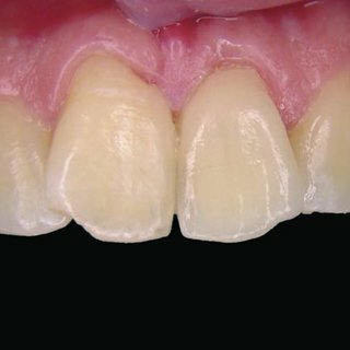 Se introducen las restauraciones de cerámica sin metal Procera