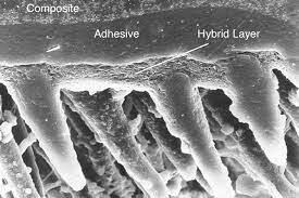 Adhesivos de cuarta generación. Éxito en odontología adhesiva.