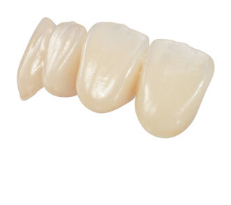 Se introdujo la zirconia In-Ceram.
