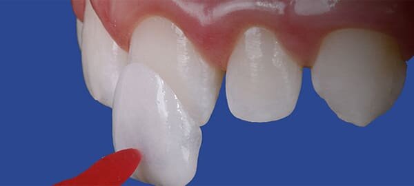 Primeras carillas dentales