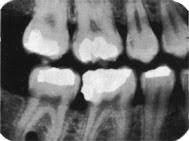 1998 Parsell D. y col. estudiaron el efecto en las restauraciones de amalgama desbordantes en relación con el periiodonto.