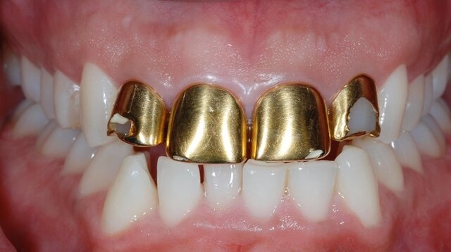 Diseño de corona de oro con un poste de oro.