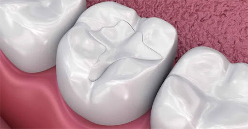 2011 Estudios in vitro muestra la biocompatibilidad de los silicatos cálcicos vehiculizados a través de resinas compuestas experimentales.