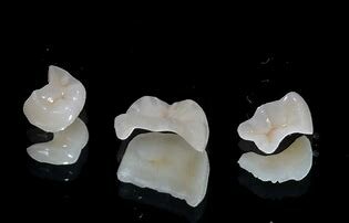 Incrustaciones de porcelana