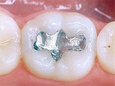 Amalgama dental
