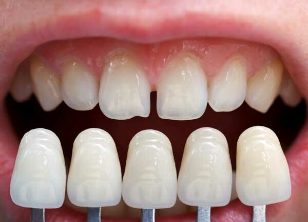 Dientes de porcelana
