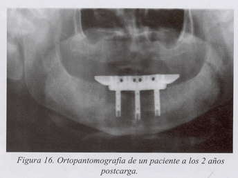 La ADA da su aprobación provisional para comercialización de implantes en USA