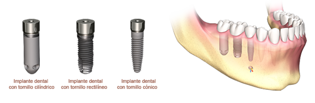 Aprobación de otros sistemas de implantes