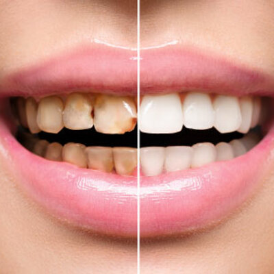 Timeline: Odontología Restauradora/ Flores Olivas Denisse/Grupo151-3