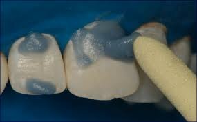 Pasta con ácido fosfórico al 37% asociado a piedra pómez