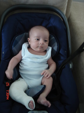 Já estou com o gesso