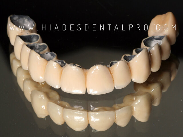 Se introdujo el sistema de cerámica de metal que utilizó aproximadamente 17-25% en peso de porcelana feldespática que contiene leucita para mejorar el coeficiente de expansión térmica entre la estructura metálica y la cerámica de recubrimiento.