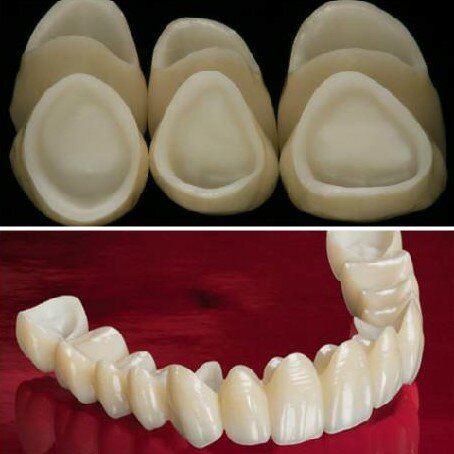 Coronas de cerámica