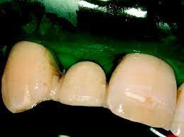 Resina compuesta reforzada con fibra