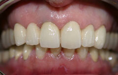 Restauraciones de cerámica sin metal Procera