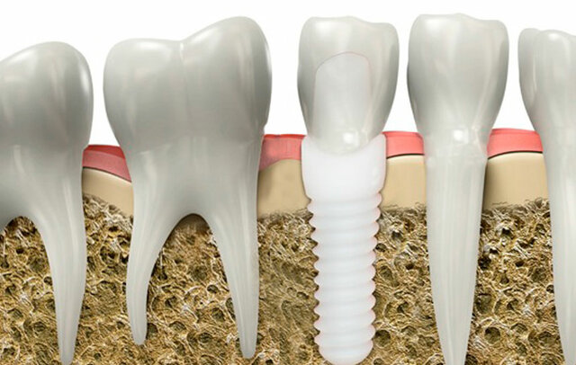 Implantes de Zirconia (Y-TZP)