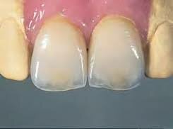 Vita In-Ceram Spinell