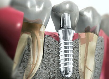 El primer implante dental de titanio fue implantado en voluntarios por el cirujano ortopédico Branemark