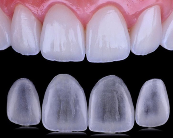 Comercialización de las carillas de porcelana