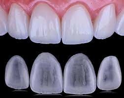 Comercialización de las carillas de porcelana