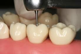 Preparación cavitaria